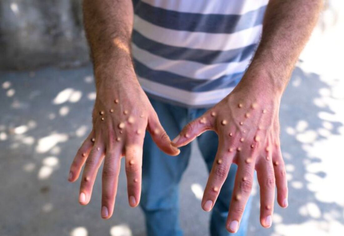 Healthcaretoday, Malaysia health, Mpox outbreak, public health, WHO alert, disease prevention, health surveillance, travel safety, infectious diseases, Mpox awareness, global health, health security, pandemic preparedness, viral infections, emergency response, Health Ministry, medical alert, healthcare, public safety, virus prevention, health guidelines, Monkeypox, smallpox, 