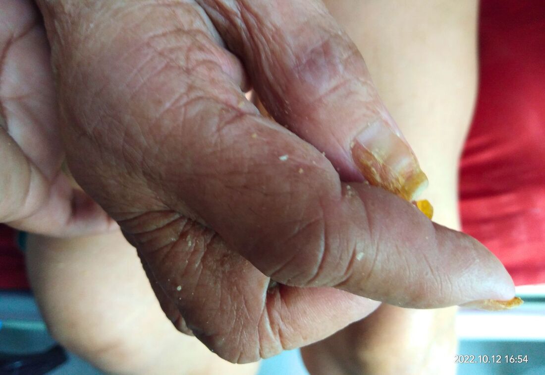 healthcaretoday, ageing, seniors, aging, elderlycare, disabled, caregivers, caregiving, burnout, respite care sole caregivers, Alzheimer's, Parkinson, dementia, sundowning, flu vaccination, influenza, lung, dizziness, falls, respiratory distress, elder abuse