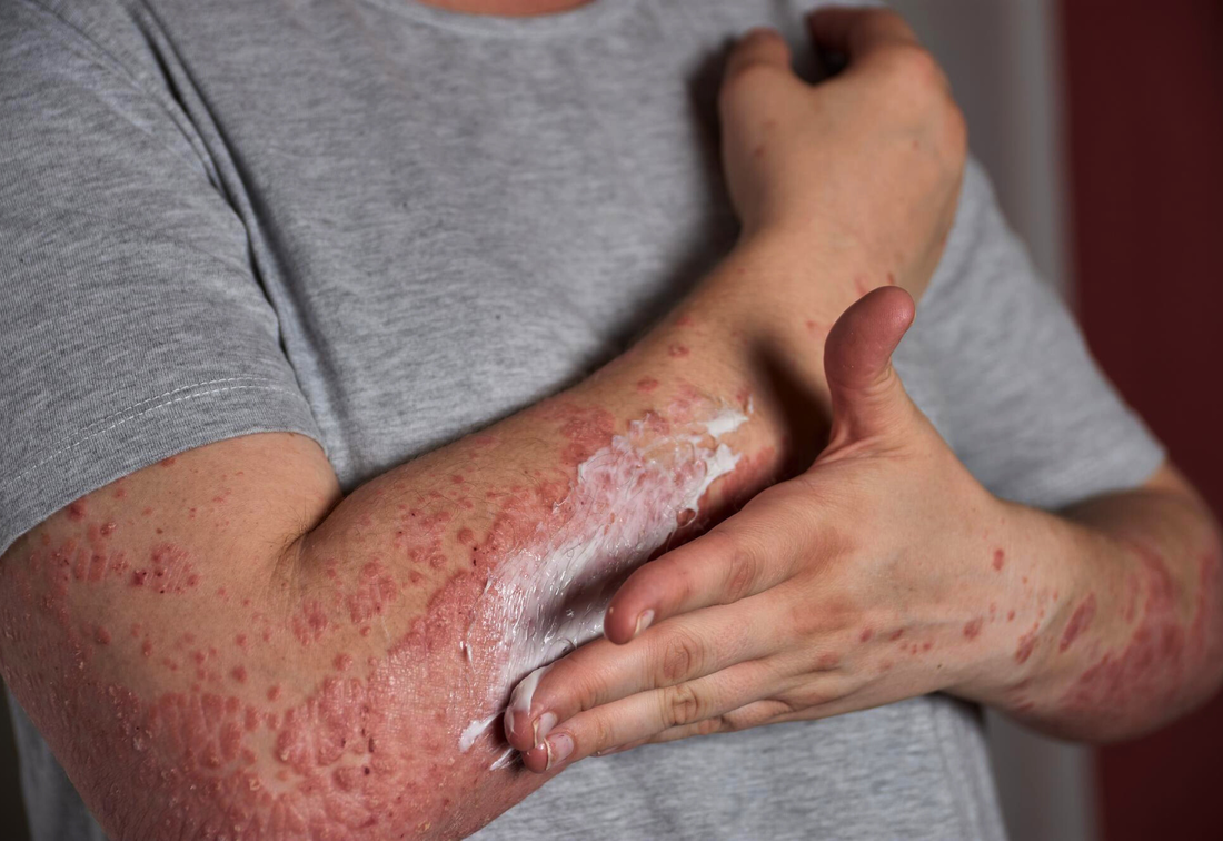 healthcaretoday, psoriasis awareness, psoriasis treatment,  chronic illness, skin health, psoriatic arthritis, mental health matters,  immune health,  autoimmune disease, end the stigma, psoriasis support, psoriasis facts,  psoriasis, dermatology care, 