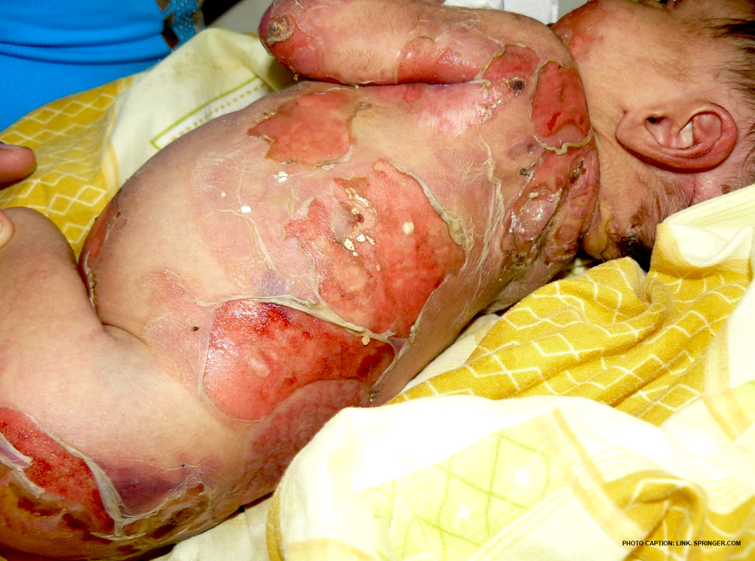 Healthcaretoday, Epidermolysis bullosa, butterfly children, children, epidermolysis bullosa in Malaysia, skin, fragile, fragile skin, infants, butterfly, inherited disease, inherited, skin disorder