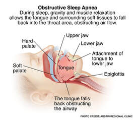 healthcaretoday, sleep apnea, daytime sleepiness, disrupted sleep, tiredness, CPAP, obesity, snoring 