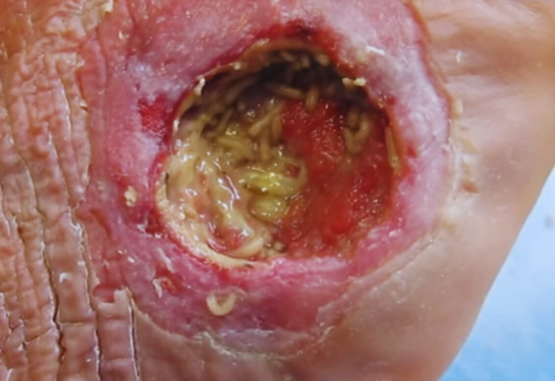 Healthcaretoday, Maggot Debridement Therapy,  Limb preservation, wound healing, amputation prevention,  diabetic foot care, chronic wounds, wound management, maggot therapy, patient care, promote tissue regeneration, 
