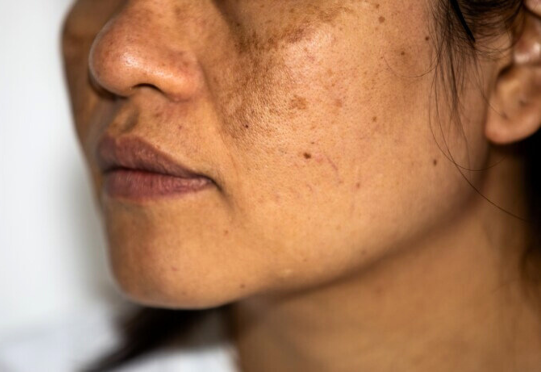 Healthcaretoday, AMSC,  Aesthetic Medicine Surgery Conference Exhibition, Melasma, Melasma treatment, hyperpigmentation, chronic melasma, topical treatments, combination therapy, photoprotection, skin care,