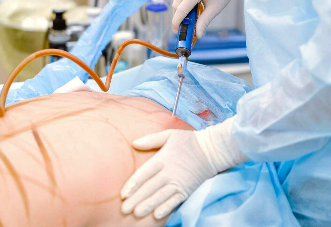 healthcaretoday, AMSC2024, liposuction, body contouring, body reshaping, fat removal, abdominoplasty, Dr Ananda Dorai, 