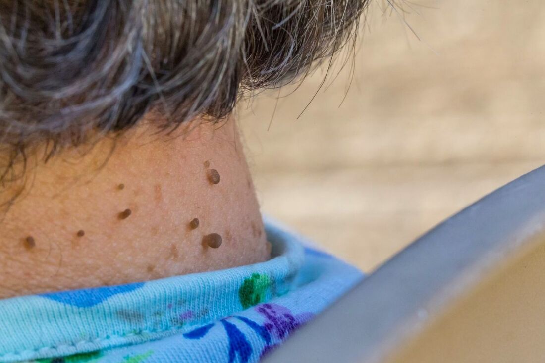 Healthcaretoday, Assunta Hospital, Diabetes, Diabetes care, Dermatology, Skin health, skin tags, Diabetes Mellitus, Acanthosis nigricans, Diabetes awareness, Diabetes complications, Metabolic health, Diabetic foot, Skin infections, fungal infections, 