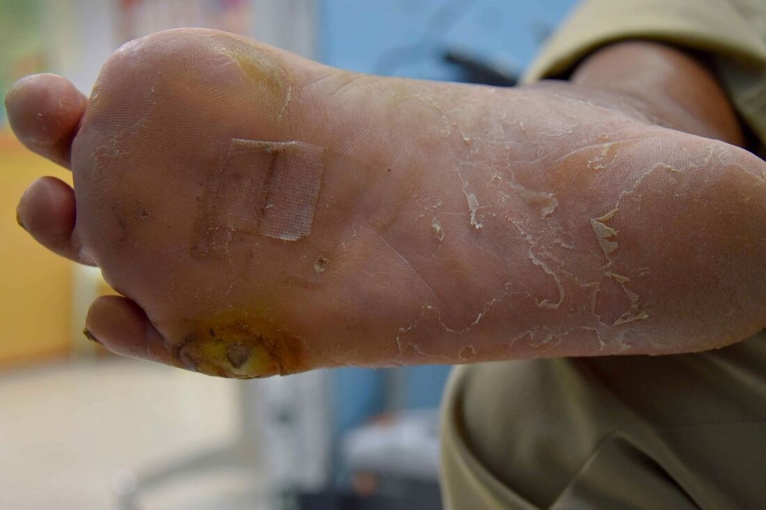 Healthcaretoday, Assunta Hospital, Diabetes, Diabetic Foot Ulcer, Diabetes care, Foot health, Prevent amputation, Wound care,  Diabetes management, Orthopaedics, Patient education, 