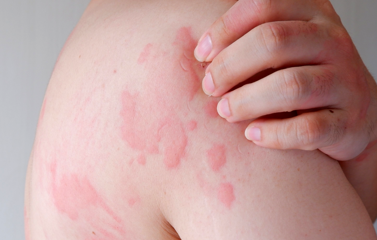 Healthcaretoday, AMSC,  Aesthetic Medicine Surgery Conference Exhibition, sensitive skin, dermatological issues, skin allergy, moisturizers,  probiotics, skin, skin health, dermatology tips,  eczema relief, dermatitis,  rosacea treatment, allergic reactio