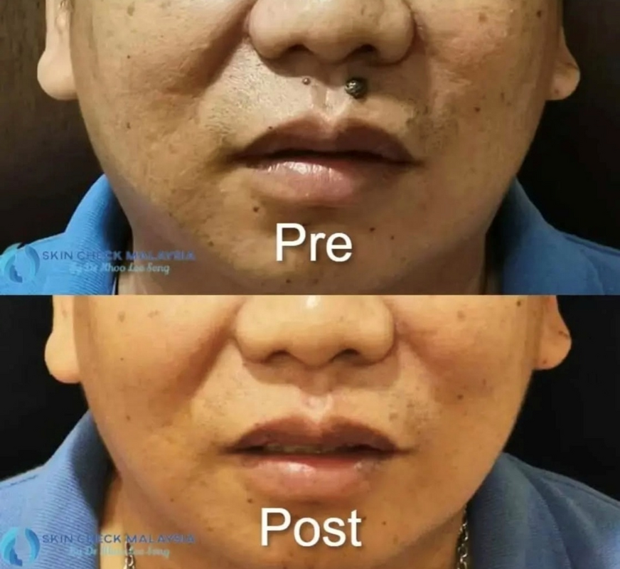 Healthcaretoday, Dr Khoo Lee Seng, Skin Check Malaysia, facial feng shui, neck-lift, frown lines, feng shui, facial reading, rhinoplasty, chin augmentation, midface lift, eyebag, mole transplant, jaw surgery, 