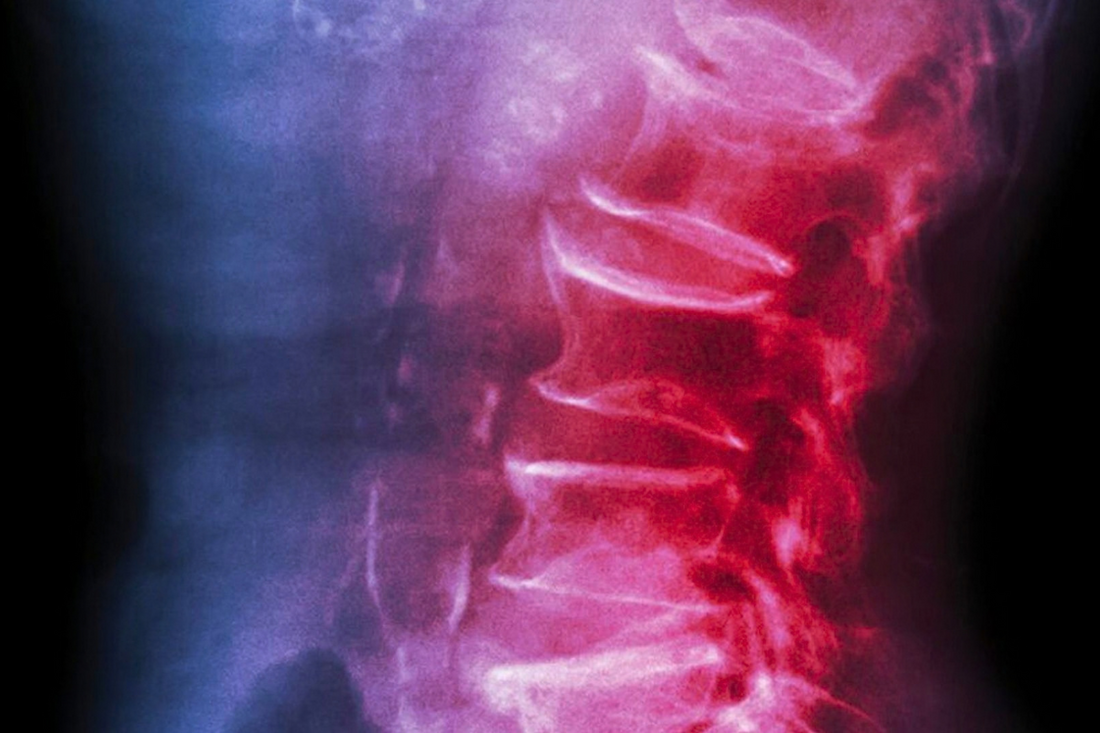 Healthcaretoday, osteoporosis, bone health, elderly care, fracture prevention, health awareness, aging population, wellness, fall prevention, bone density,