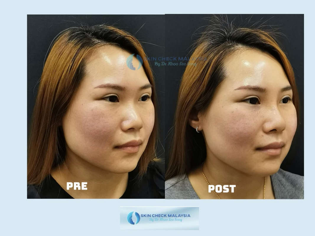 Healthcaretoday, Dr Khoo Lee Seng, Skin Check Malaysia, facial feng shui, neck-lift, frown lines, feng shui, facial reading, rhinoplasty, chin augmentation, midface lift, eyebag, mole transplant, jaw surgery, 