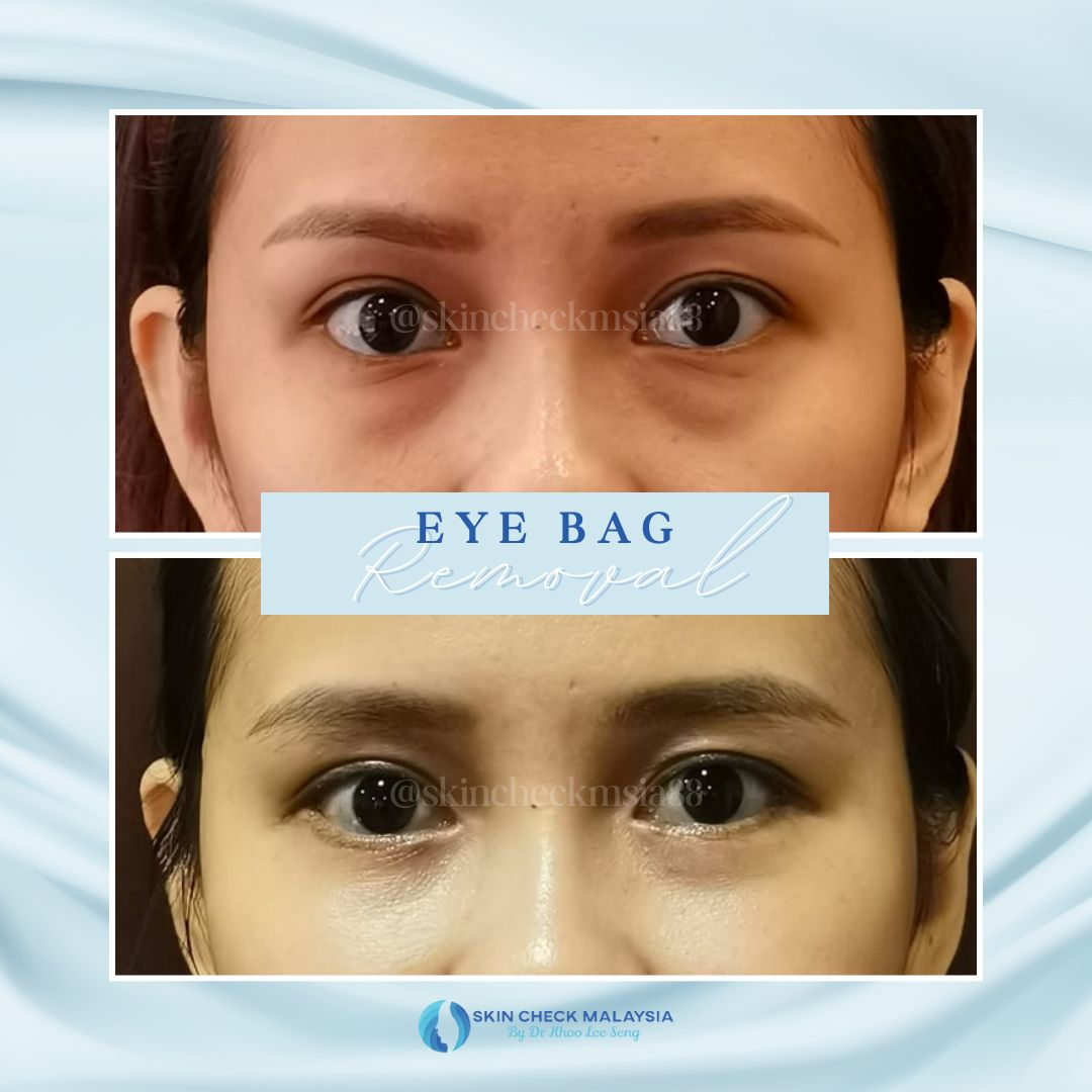Healthcaretoday, Dr Khoo Lee Seng, Skin Check Malaysia, facial feng shui, neck-lift, frown lines, feng shui, facial reading, rhinoplasty, chin augmentation, midface lift, eyebag, mole transplant, jaw surgery, 