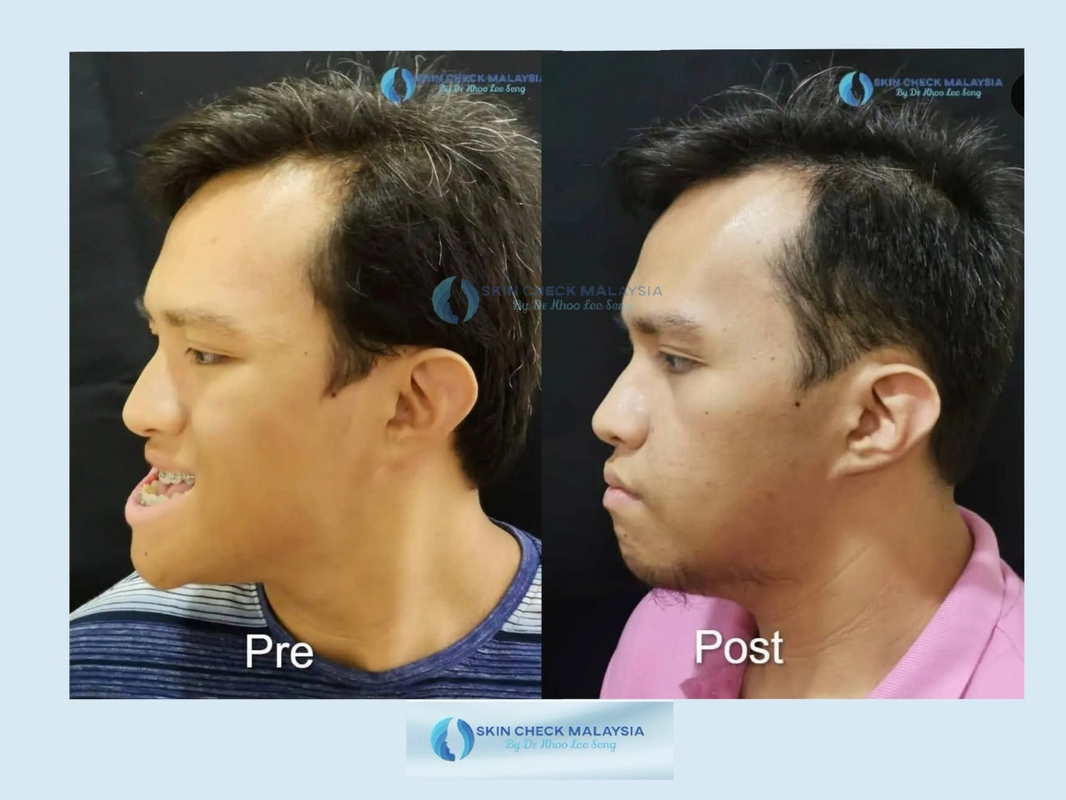Healthcaretoday, Dr Khoo Lee Seng, Skin Check Malaysia, facial feng shui, neck-lift, frown lines, feng shui, facial reading, rhinoplasty, chin augmentation, midface lift, eyebag, mole transplant, jaw surgery, 