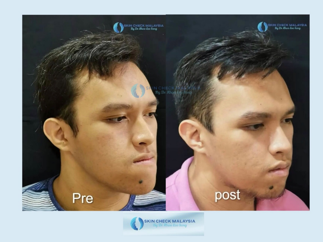 Healthcaretoday, Dr Khoo Lee Seng, Skin Check Malaysia, facial feng shui, neck-lift, frown lines, feng shui, facial reading, rhinoplasty, chin augmentation, midface lift, eyebag, mole transplant, jaw surgery, 