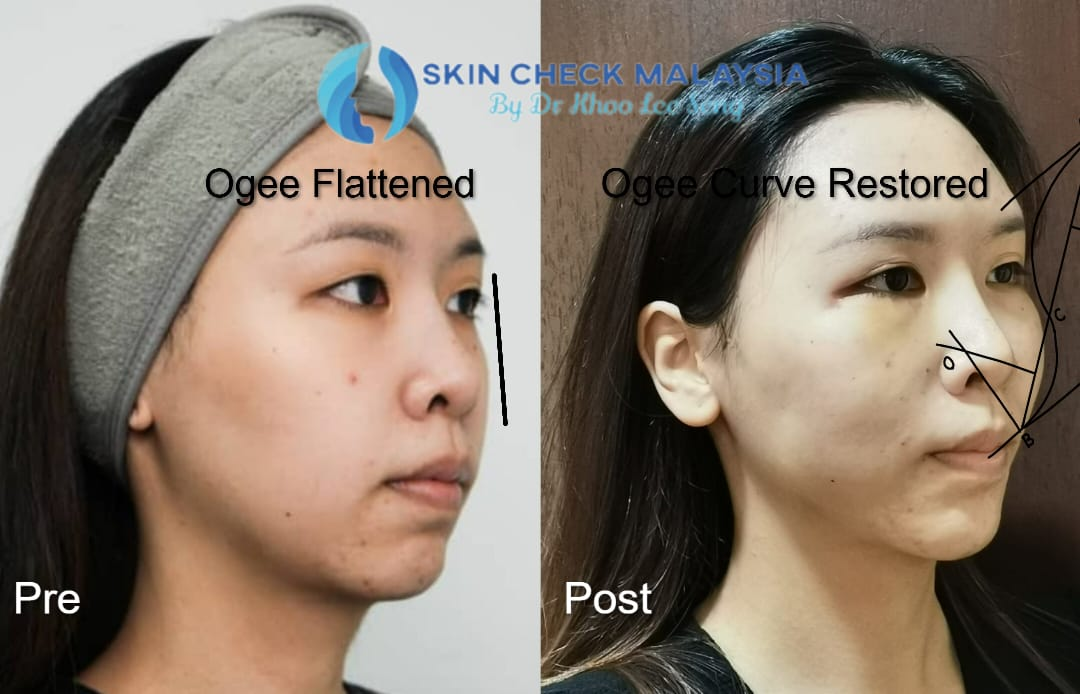 Healthcaretoday, Dr Khoo Lee Seng, Skin Check Malaysia, facial feng shui, neck-lift, frown lines, feng shui, facial reading, rhinoplasty, chin augmentation, midface lift, eyebag, mole transplant, jaw surgery, 