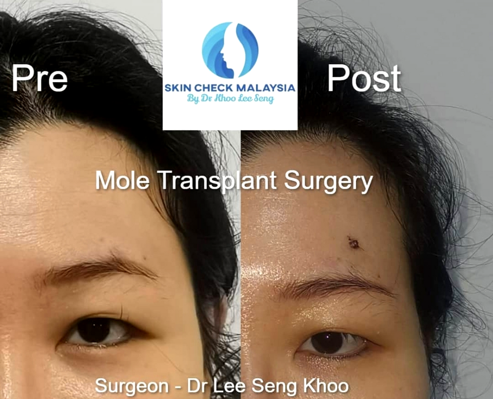 Healthcaretoday, Dr Khoo Lee Seng, Skin Check Malaysia, facial feng shui, neck-lift, frown lines, feng shui, facial reading, rhinoplasty, chin augmentation, midface lift, eyebag, mole transplant, jaw surgery, 