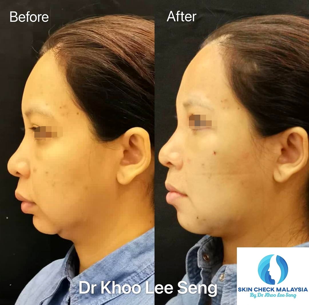 Healthcaretoday, Dr Khoo Lee Seng, Skin Check Malaysia, facial feng shui, neck-lift, frown lines, feng shui, facial reading, rhinoplasty, chin augmentation, midface lift, eyebag, mole transplant, jaw surgery, 