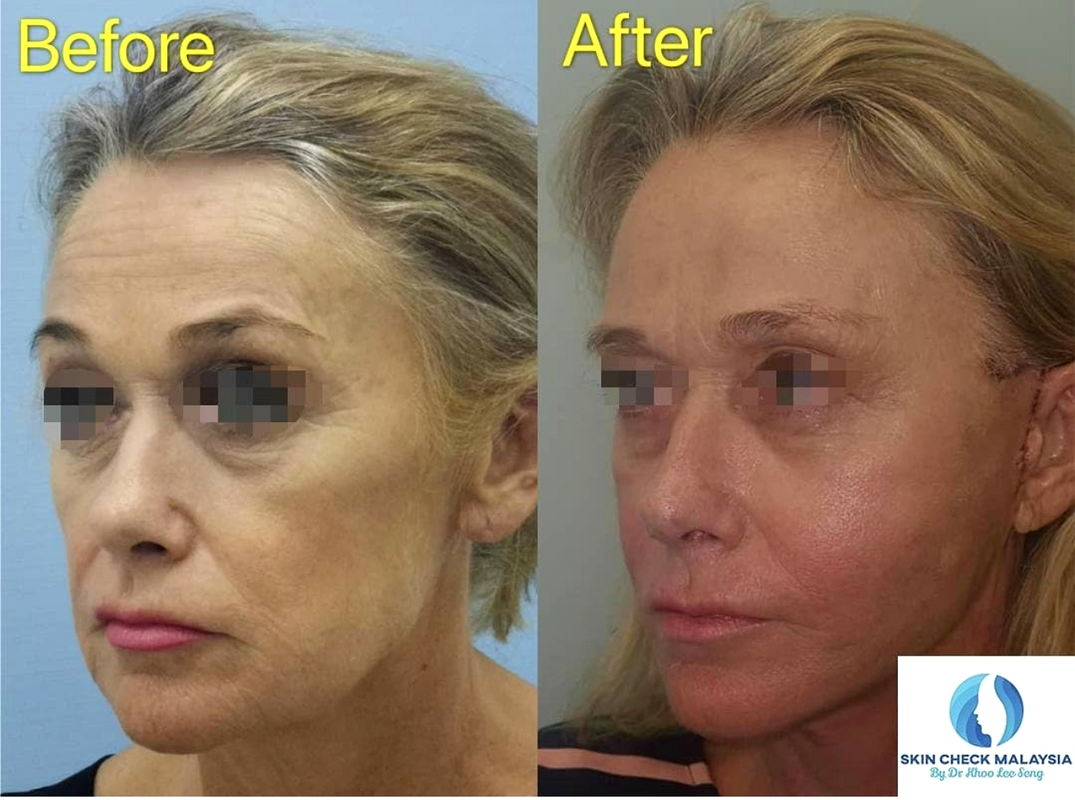 Healthcaretoday, Dr Khoo Lee Seng, Skin Check Malaysia, facial feng shui, neck-lift, frown lines, feng shui, facial reading, rhinoplasty, chin augmentation, midface lift, eyebag, mole transplant, jaw surgery, 