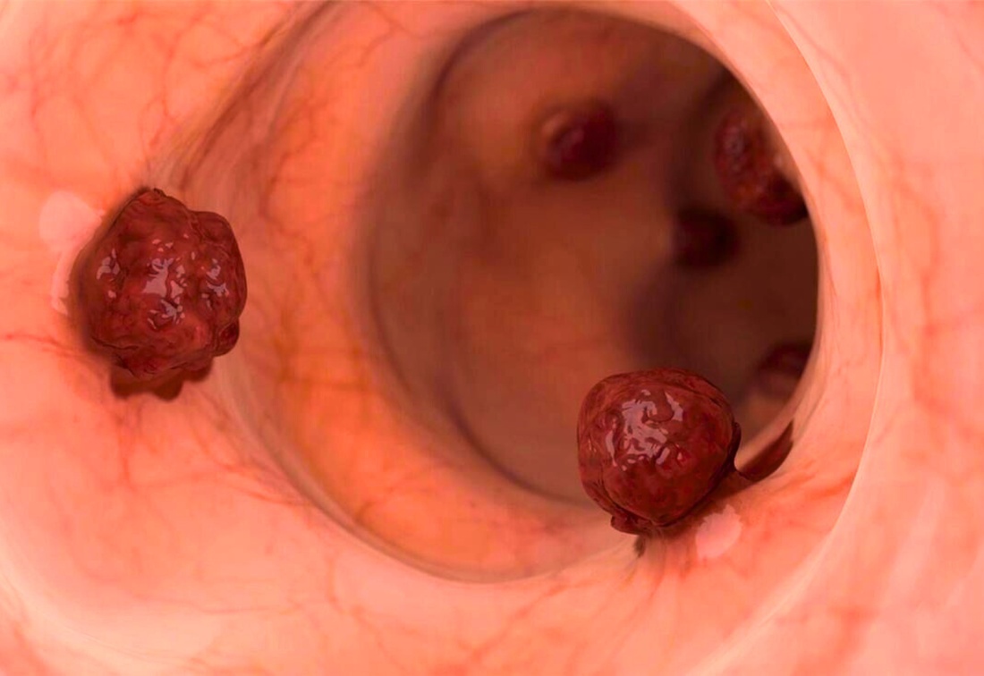 Healthcaretoday, colorectal cancer, Gleneagles Penang, Metastatic colorectal cancer, common cancer, cancer survivor, cancer fighter, constipation, diarrhoea, abdominal discomfort, weight loss, bloody stool